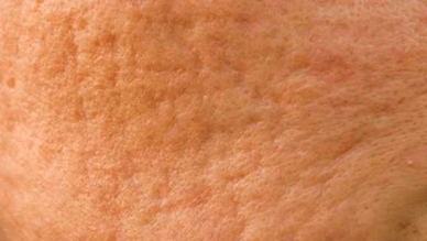 Rolling acne scars after hormo